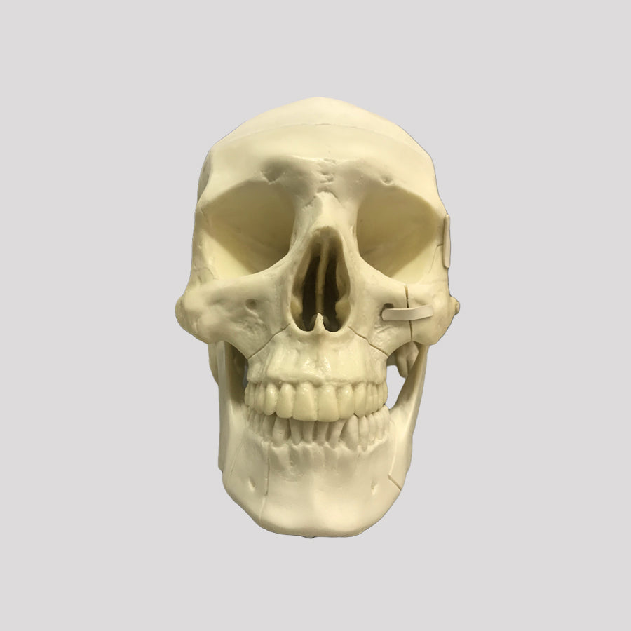 10985 SKULL WITH ZYGOMATIC FRACTURE AND SUPPORT BLOCK