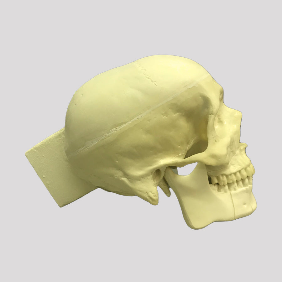 10985 SKULL WITH ZYGOMATIC FRACTURE AND SUPPORT BLOCK