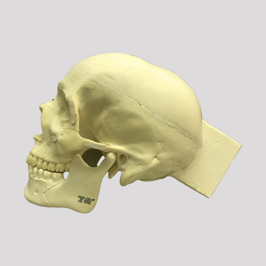 10985 SKULL WITH ZYGOMATIC FRACTURE AND SUPPORT BLOCK
