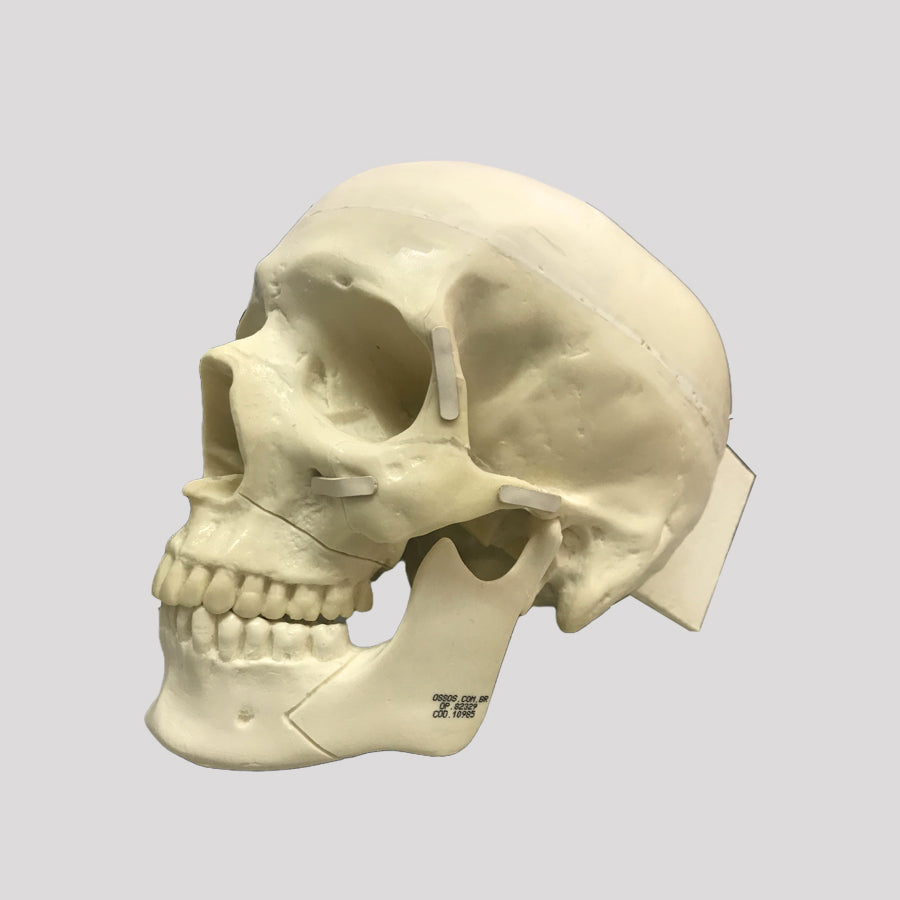 10985 SKULL WITH ZYGOMATIC FRACTURE AND SUPPORT BLOCK