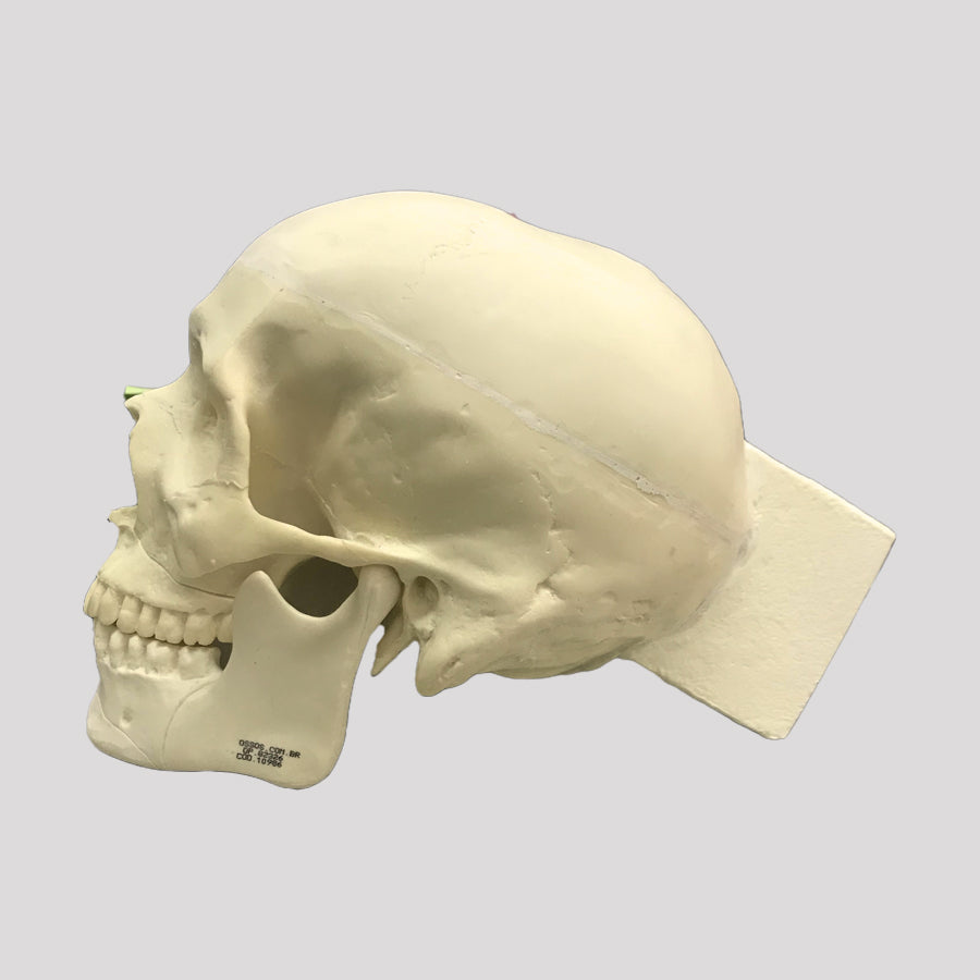 10986 - SKULL WITH LE FORT FRACTURE AND SUPPORT BLOCK