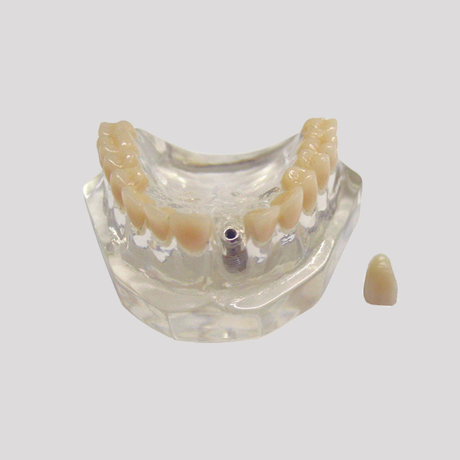 4217 A - ACRYLIC MAXILLA WITH TEETH AND 1 IMPLANT