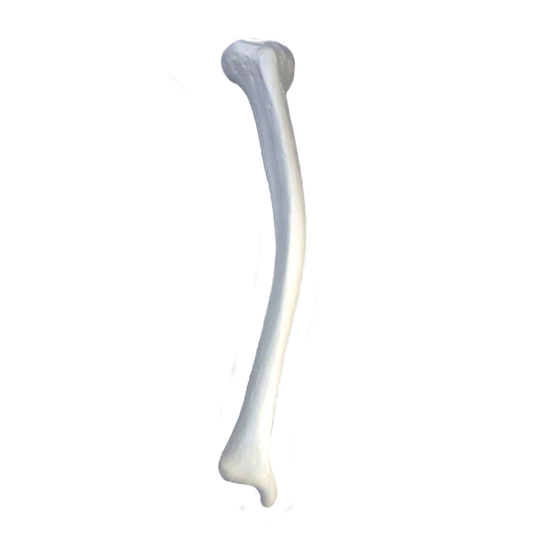 2031 D2PMPVL - RIGHT TIBIA WITH 2 PLANE MEDIAL POSTERIOR VALGUS DEFORMITY