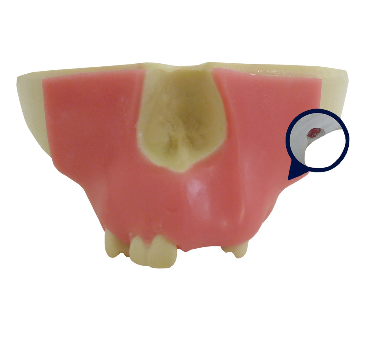 4015DIG - MAXILLA WITH 3RD MOLAR ENCLOSED AND GUM