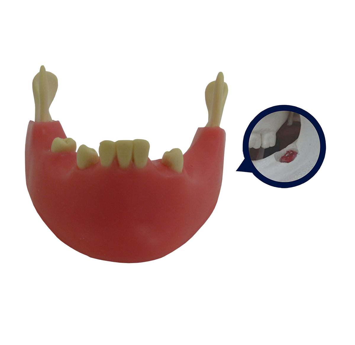 4401G-02 - PREMOLAR MODEL WITH ENCLOSED 3RD MOLAR AND GUM