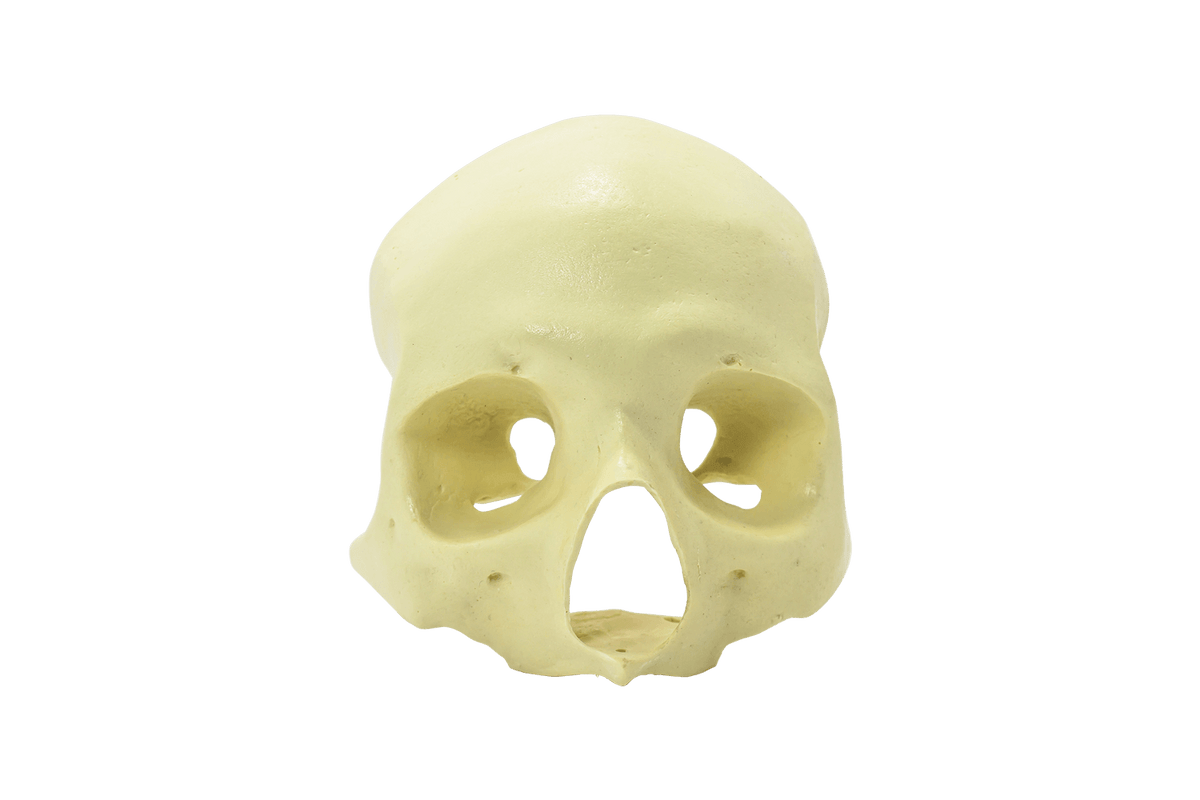 9014 - FRONTAL SKULL - ALL ON 4 - ZYGOMA