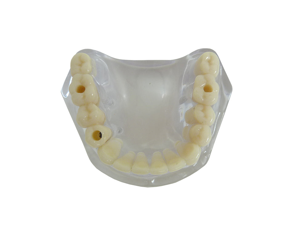 9570 – ACRYLIC MANDIBLE WITH TEETH AND 3 IMPLANTS