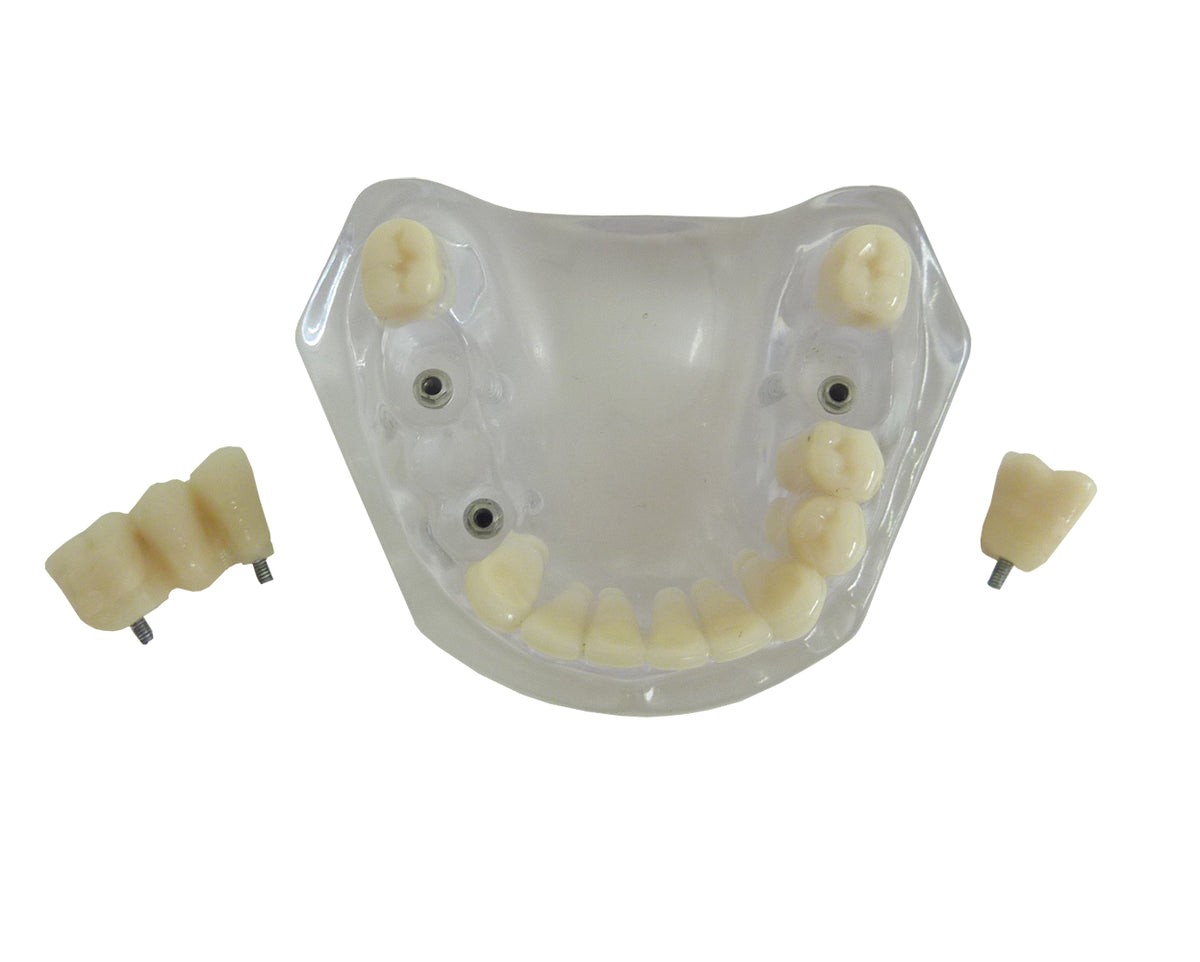 9570 – ACRYLIC MANDIBLE WITH TEETH AND 3 IMPLANTS