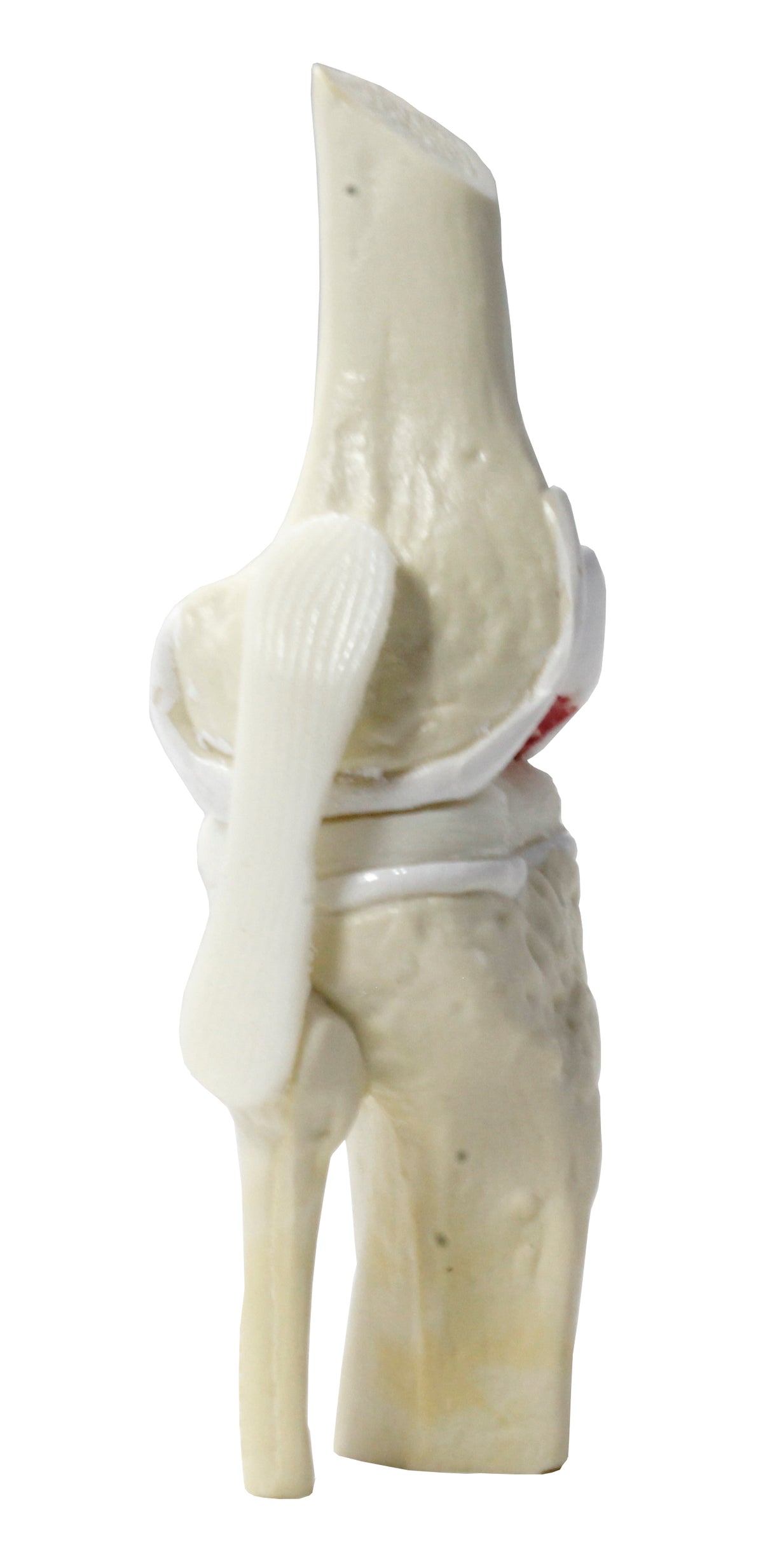 9597-2 - KNEE WITH INITIAL OSTEOARTHRITIS