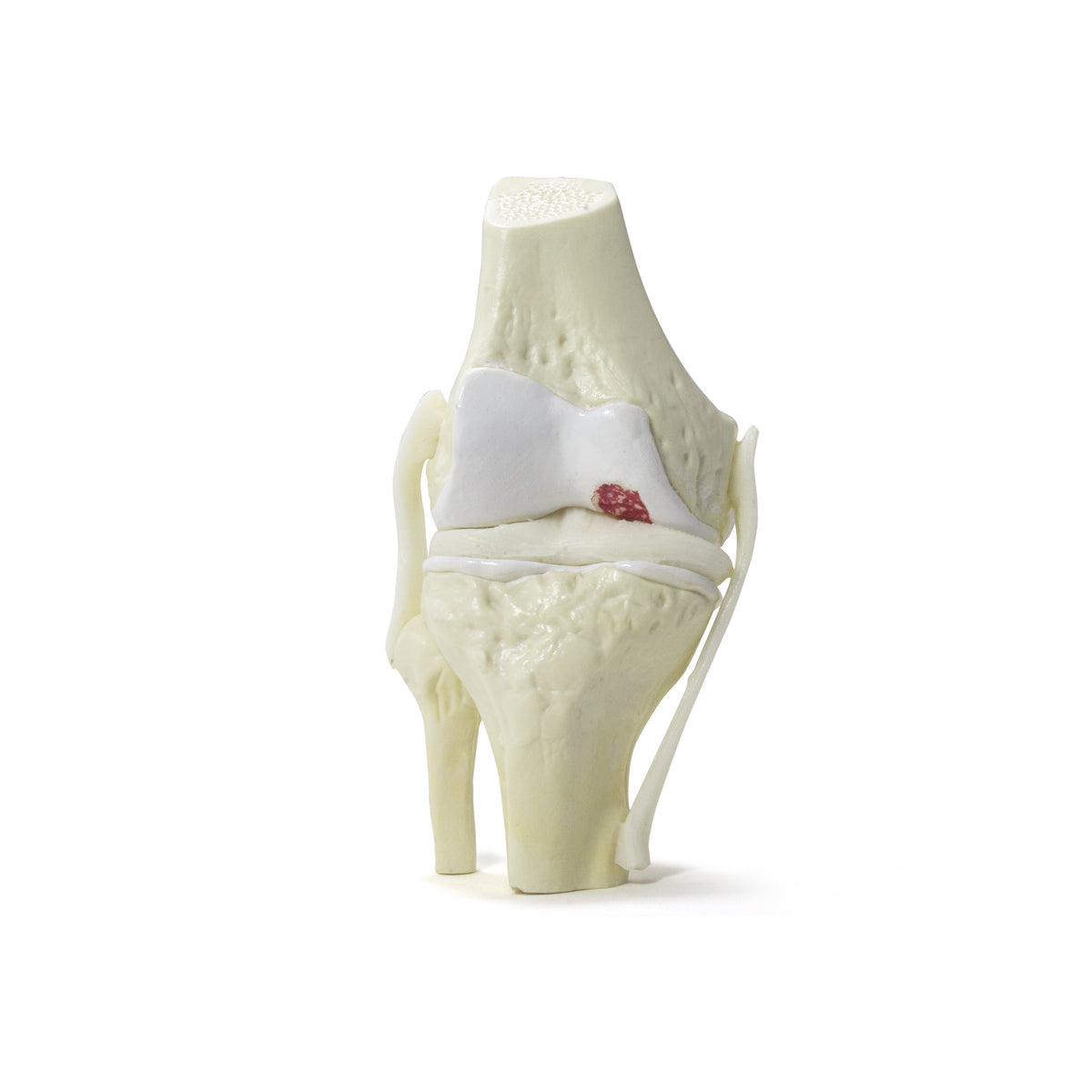 9597-2 - KNEE WITH INITIAL OSTEOARTHRITIS