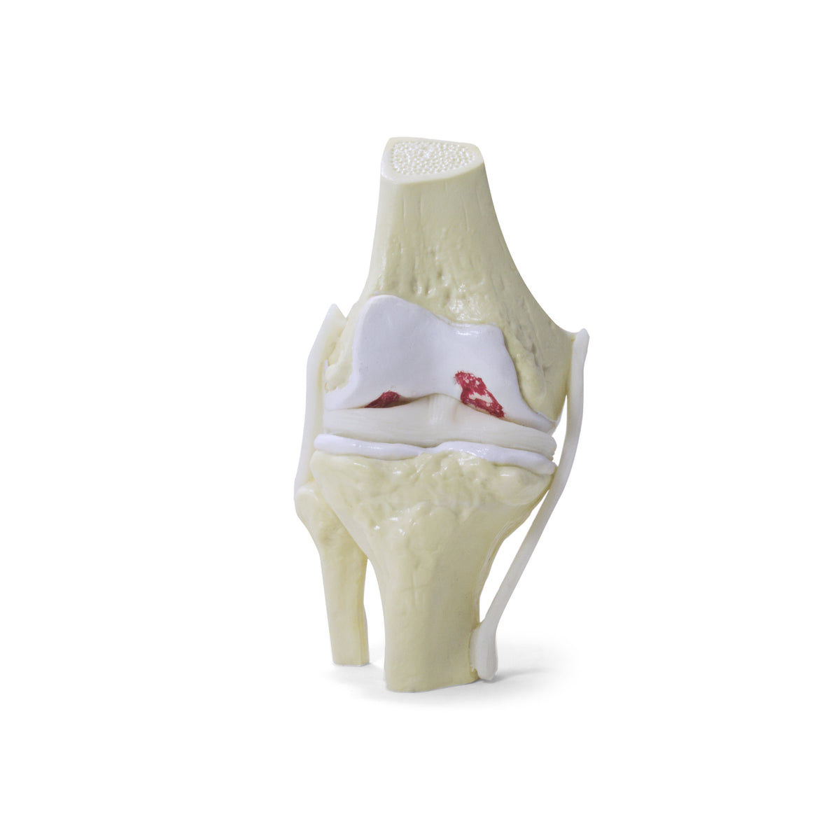9597-3 - KNEE W/ MODERATE OSTEOARTHRITIS
