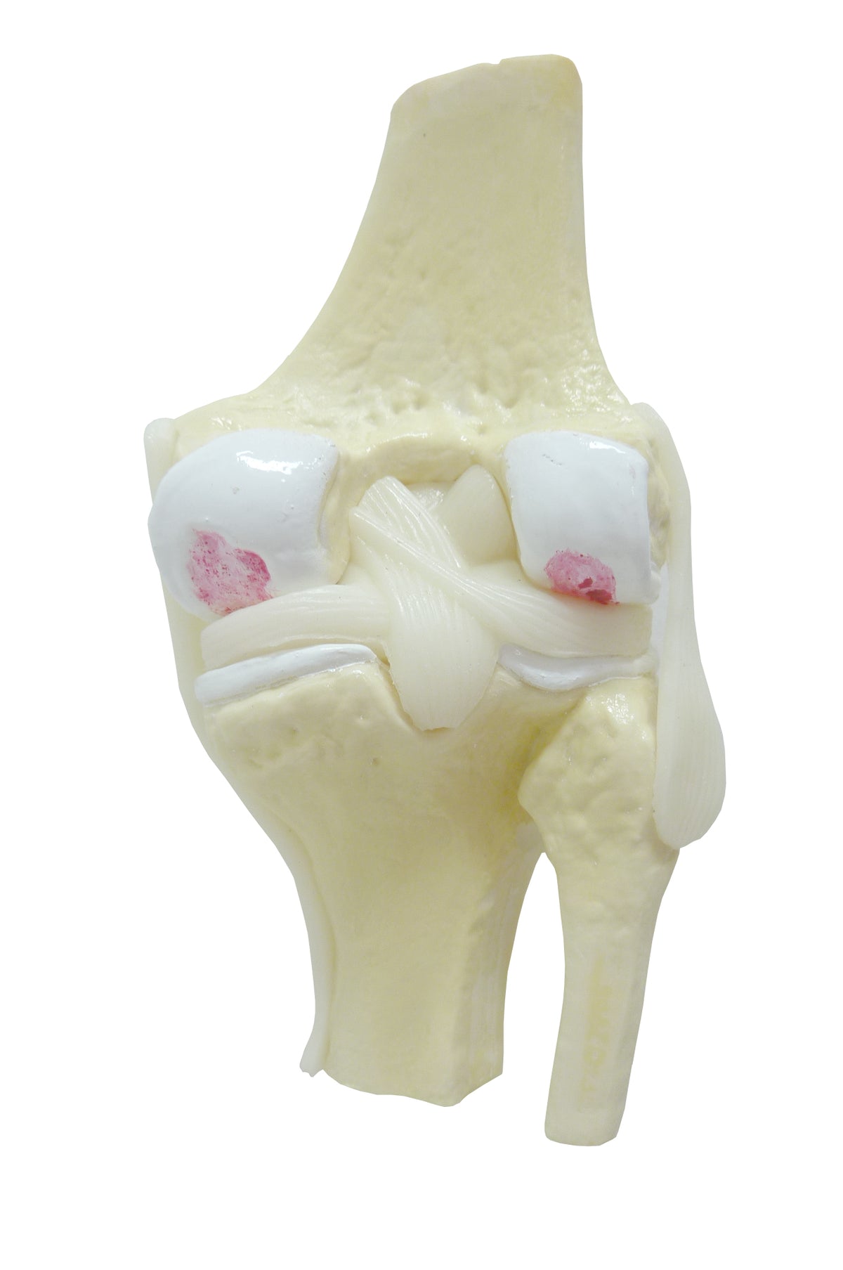 9597-3 - KNEE W/ MODERATE OSTEOARTHRITIS