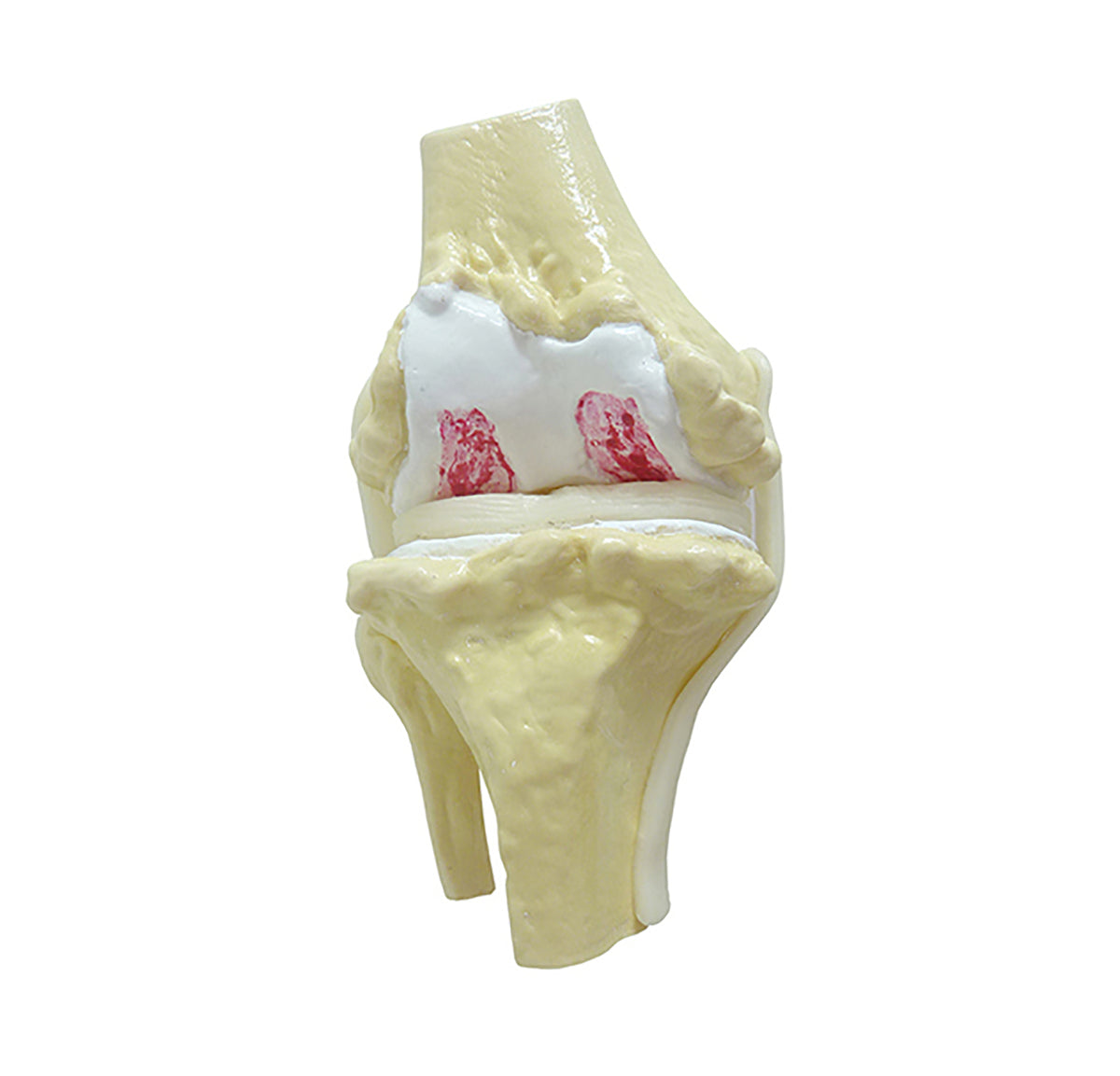 9597-4 - KNEE WITH ADVANCED OSTEOARTHRITIS