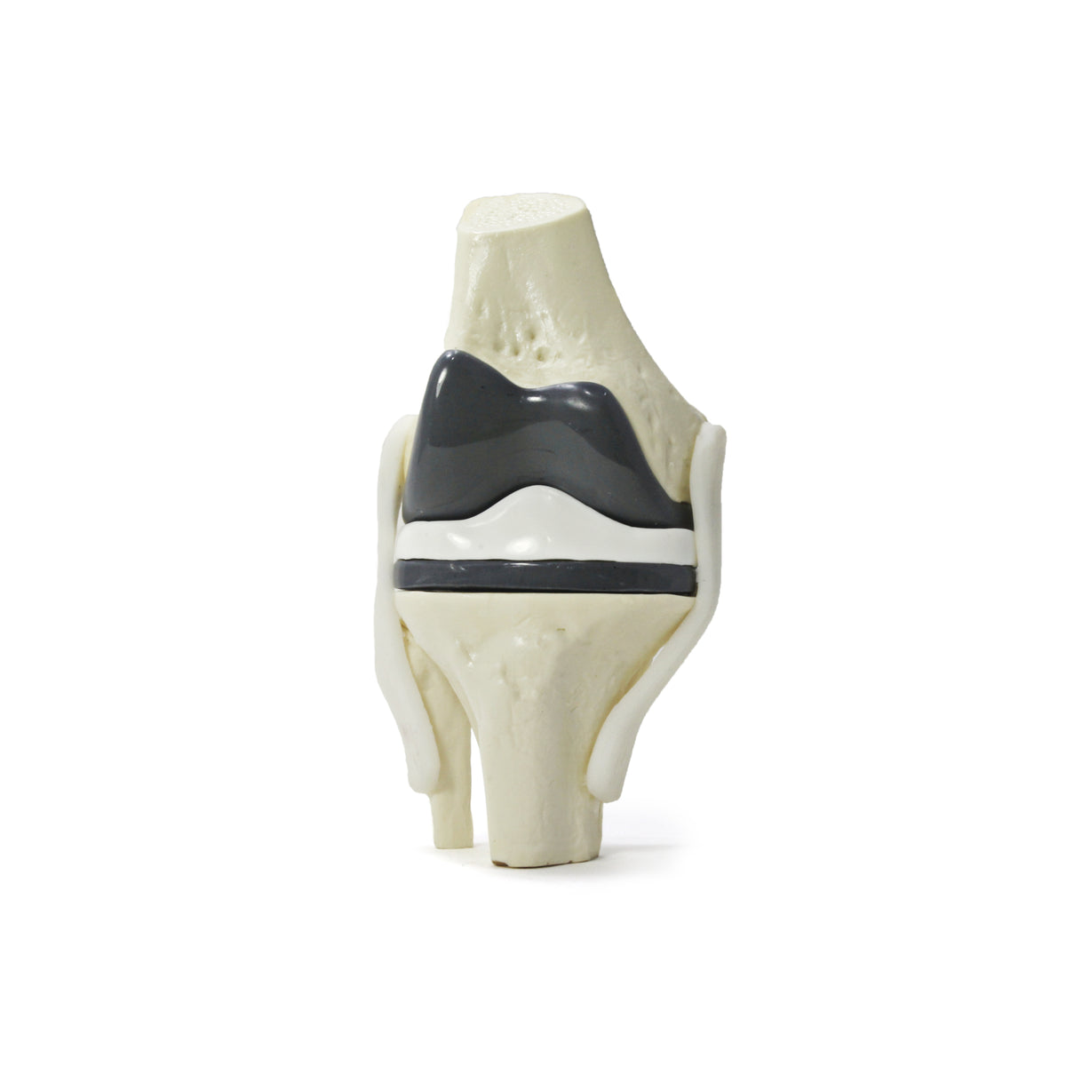 9597-5 - OSTEOARTHRITIS KNEE WITH IMPLANT