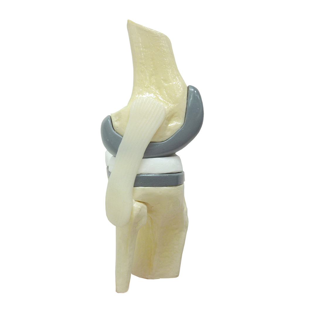9597-5 - OSTEOARTHRITIS KNEE WITH IMPLANT