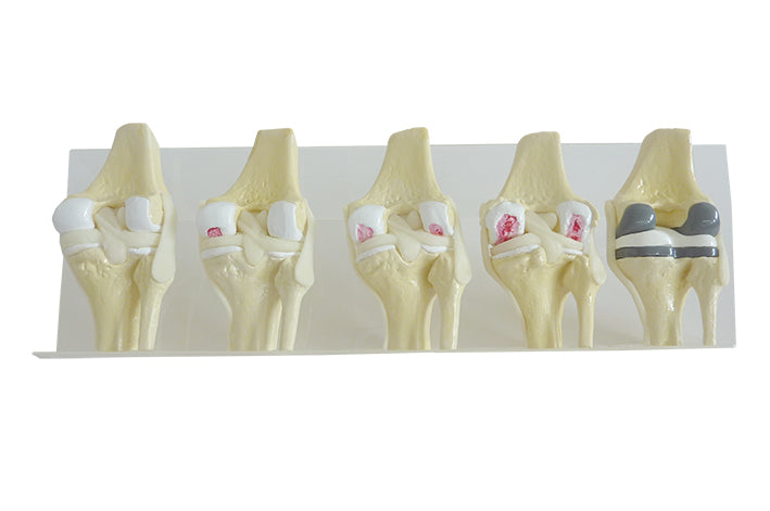 9597 - OSTEOARTHRITIS KNEE KIT (5 PIECES)