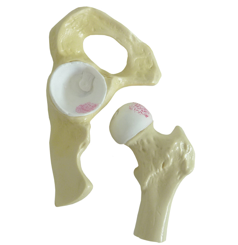 9598-2 - KNEE WITH INITIAL OSTEOARTHRITIS