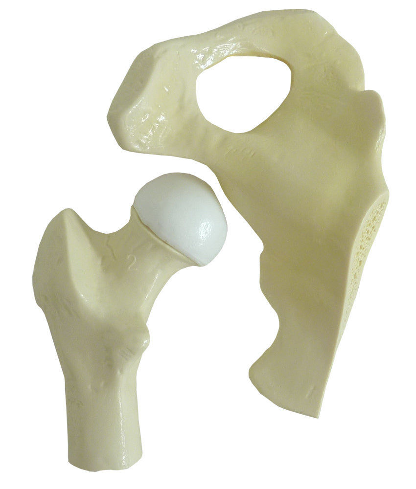 9598-2 - KNEE WITH INITIAL OSTEOARTHRITIS