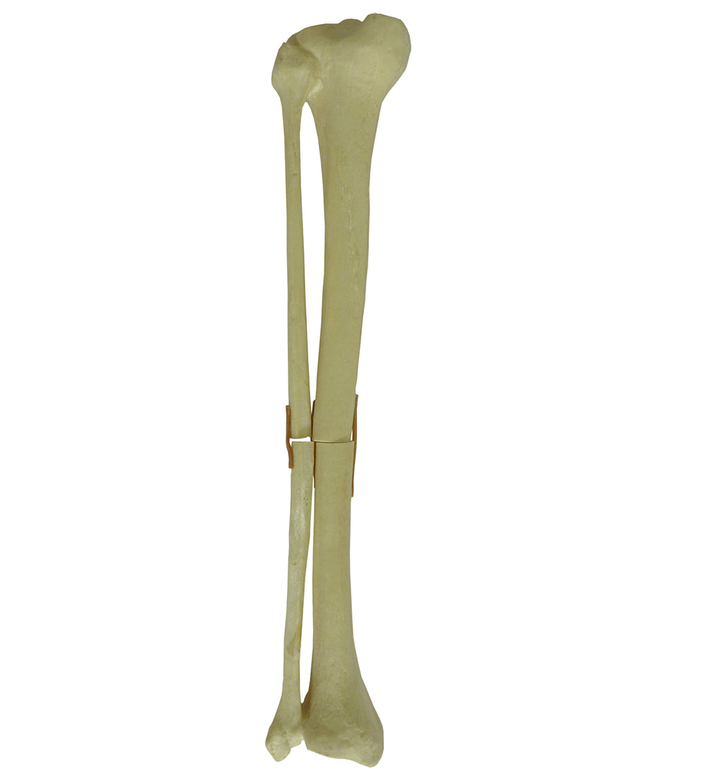9700 - LEFT TIBIA WITH MIDSHAFT FRACTURE