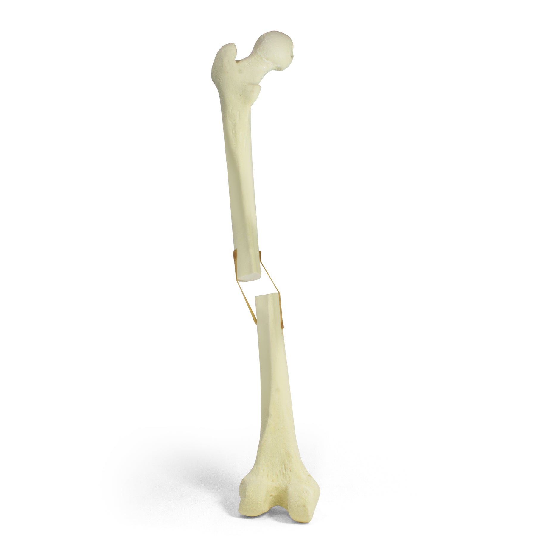 9702 - LEFT FEMUR FRACTURE 1