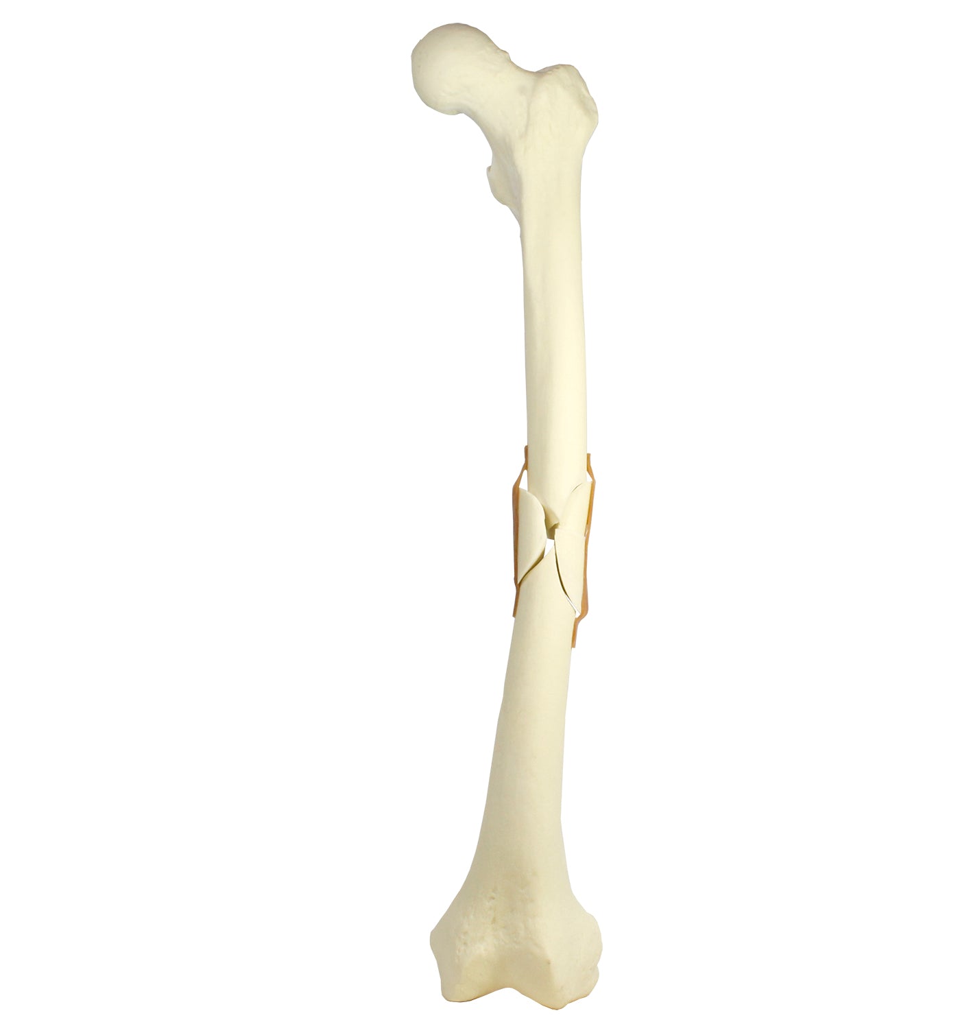 9703 - LEFT FEMUR FRACTURE 2