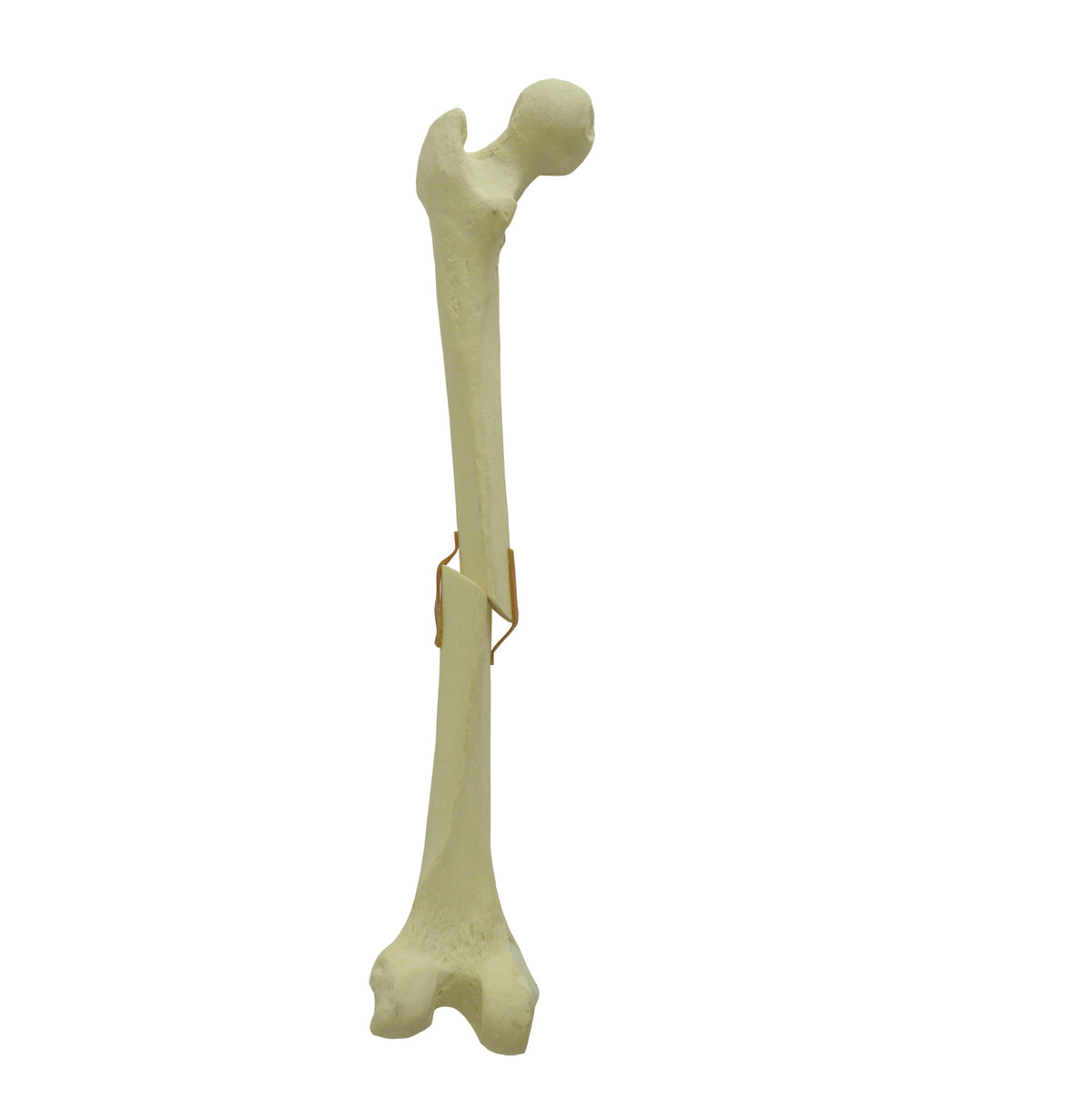 9704 - LEFT FEMUR FRACTURE 3