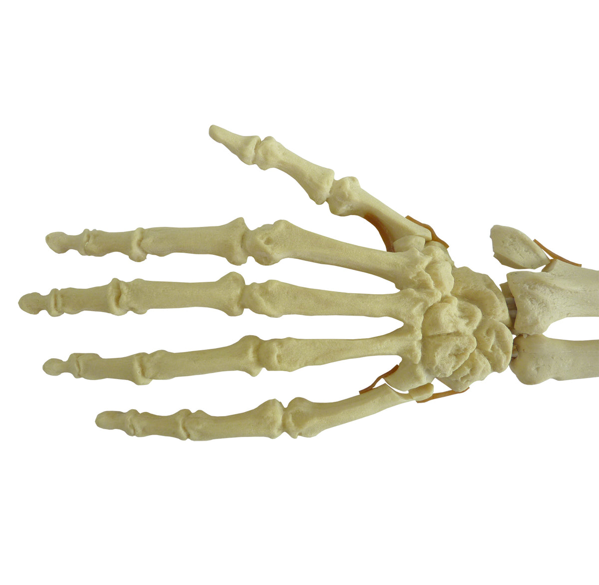 12355 - RADIOPAQUE LEFT HAND - FRACTURE 1