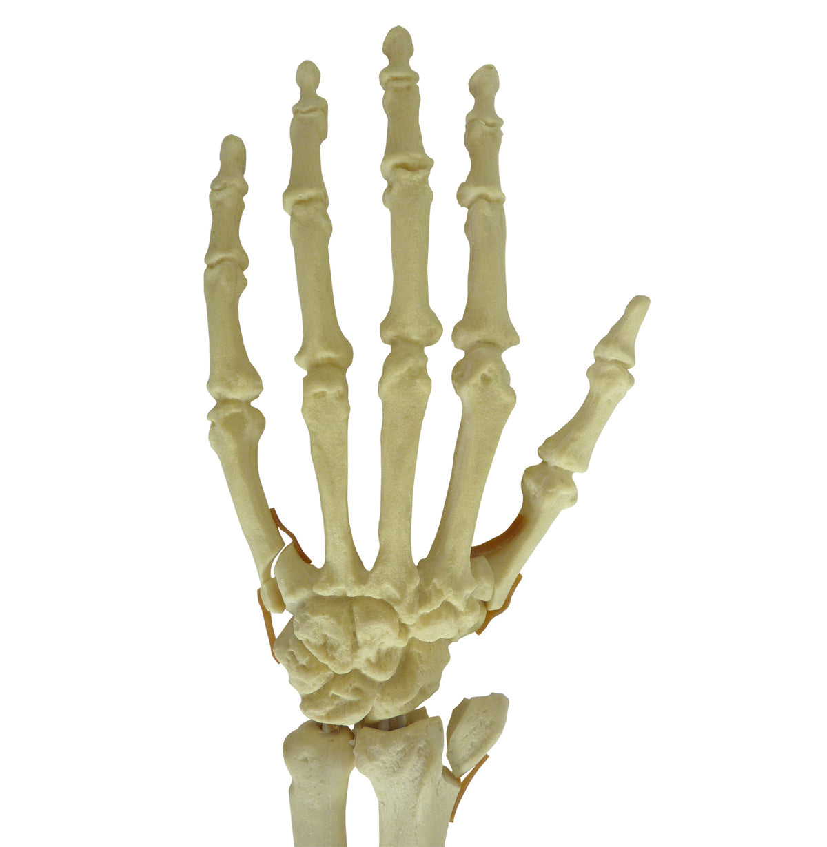 9705 - LEFT HANDLE - FRACTURE 1