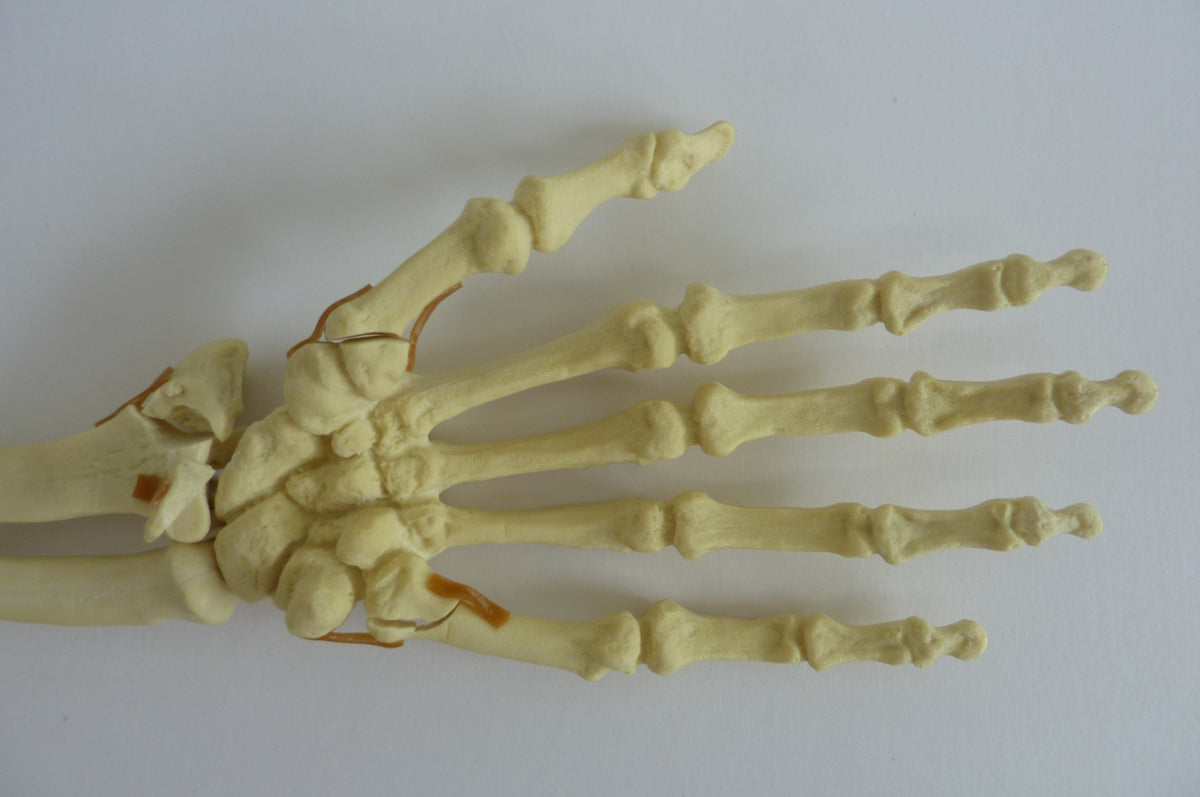 12355 - RADIOPAQUE LEFT HAND - FRACTURE 1