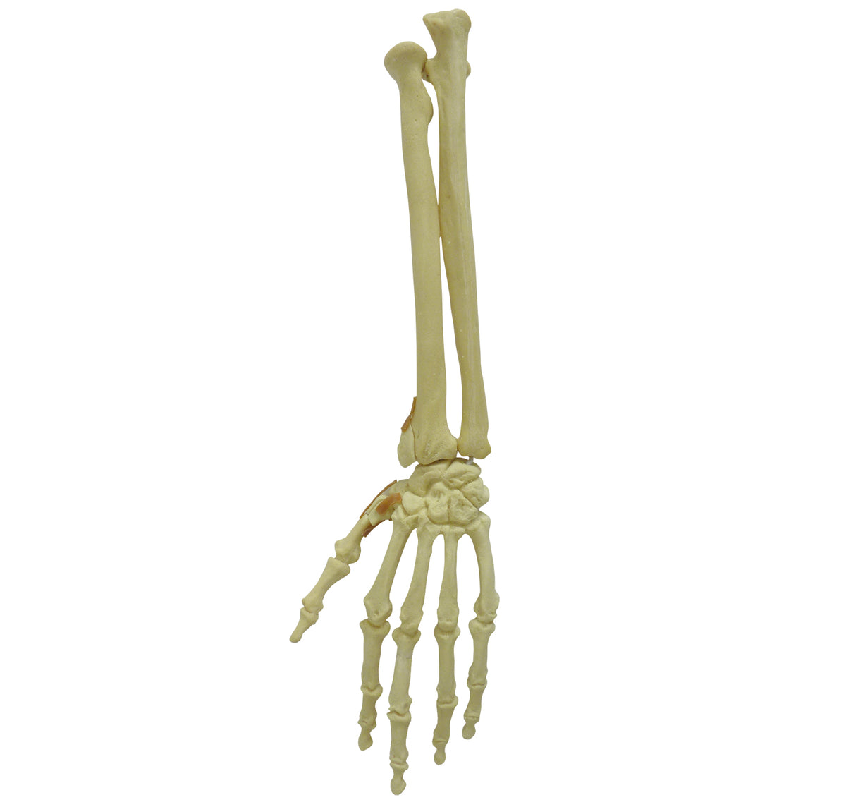 12356 - RADIOPAQUE LEFT WRIST - FRACTURE 2