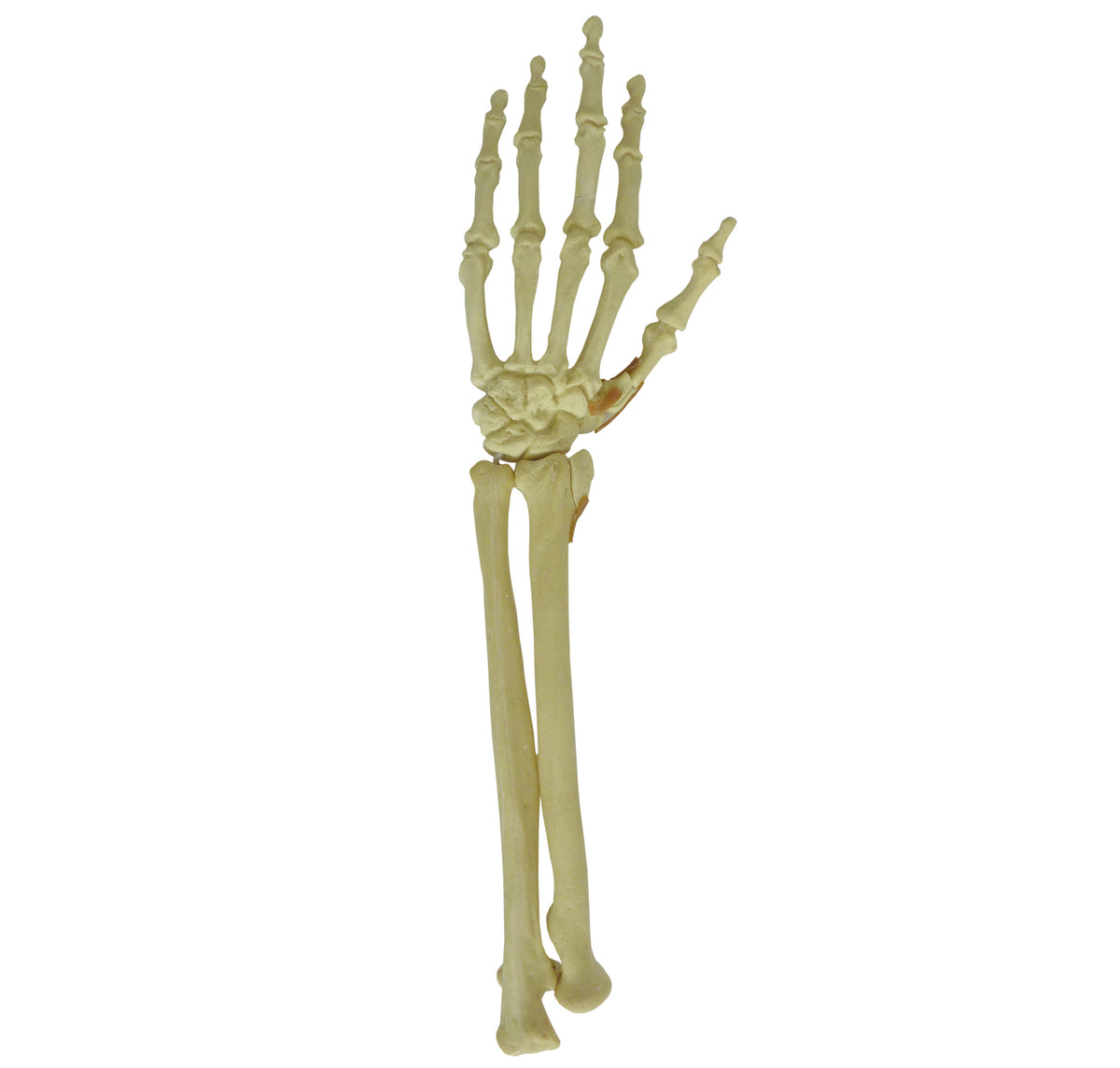 9706 - LEFT WRIST - FRACTURE 2