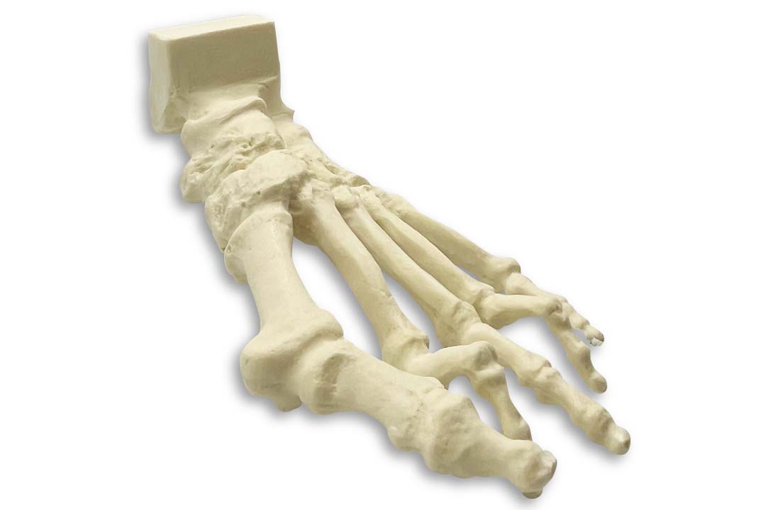 1006-01 - LEFT FOOT WITH DEFORMITIES