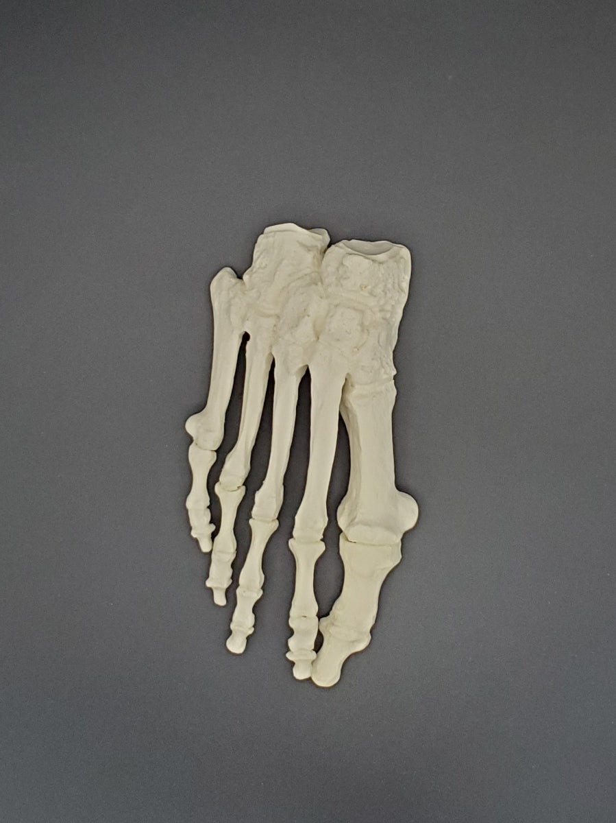 13416 - RIGHT FOREFOOT / MIDFOOT WITH DEFORMITY