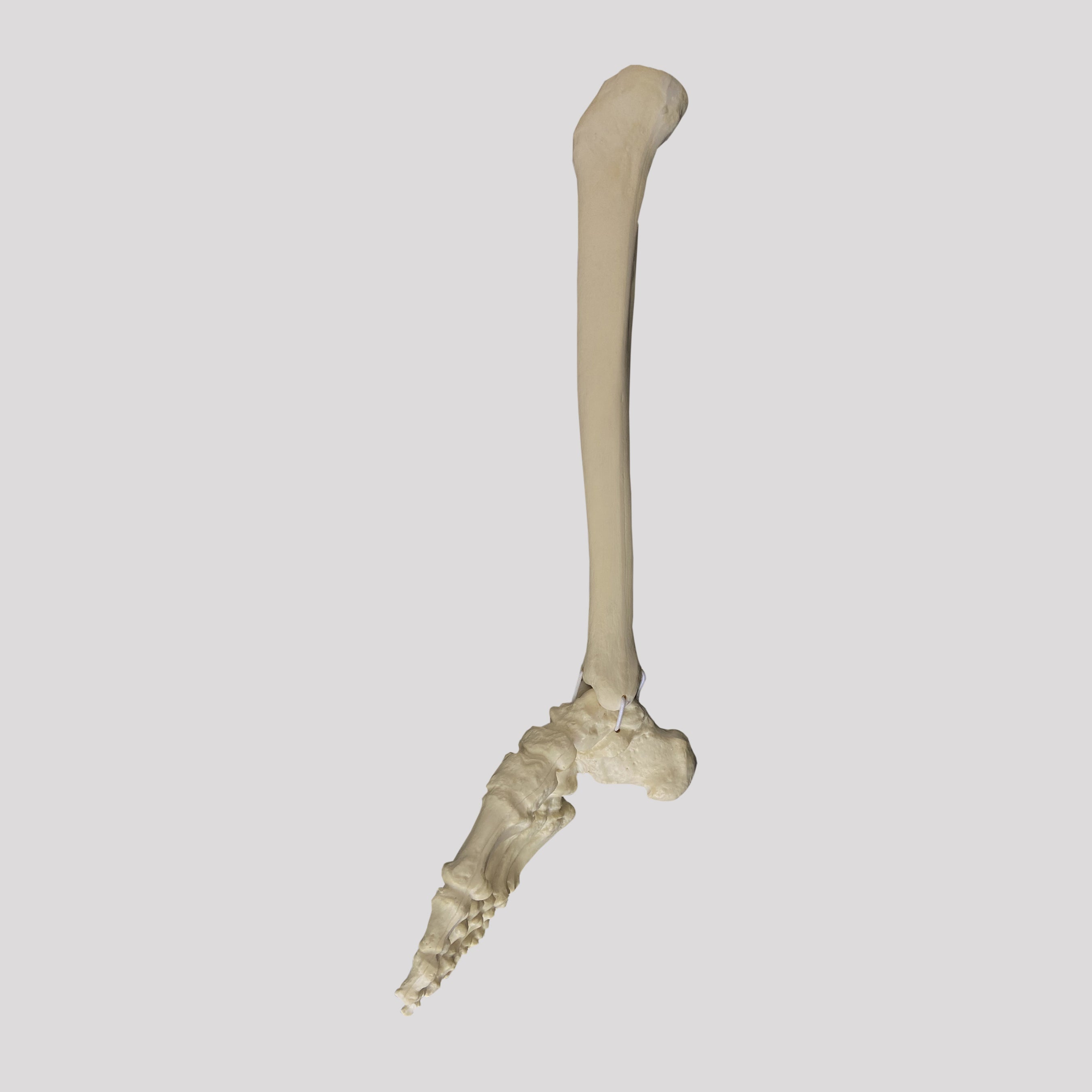 12454 - RIGHT CONGENITAL FOOT WITH TIBIA