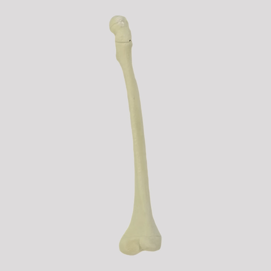 1018 - CHILD RIGHT FEMUR WITH CANAL AND ANTEVERSION DEFORMITY