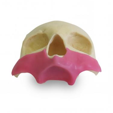 9014G - FRONTAL SKULL - ALL ON 4 - ZYGOMATIC IMPLANT WITH GUM