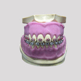 4033GAP - ORTHODONTIC DUMMY WITH EXPOSED GUMS ROOT AND BRACES