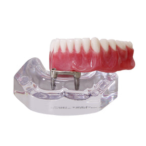 9567 – ACRYLIC MANDIBLE WITH CLIP BAR AND PROSTHESIS