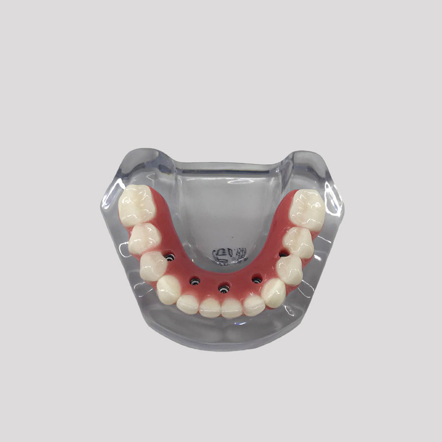 9569 - ACRYLIC MANDIBLE WITH PROTOCOL AND 5 IMPLANTS