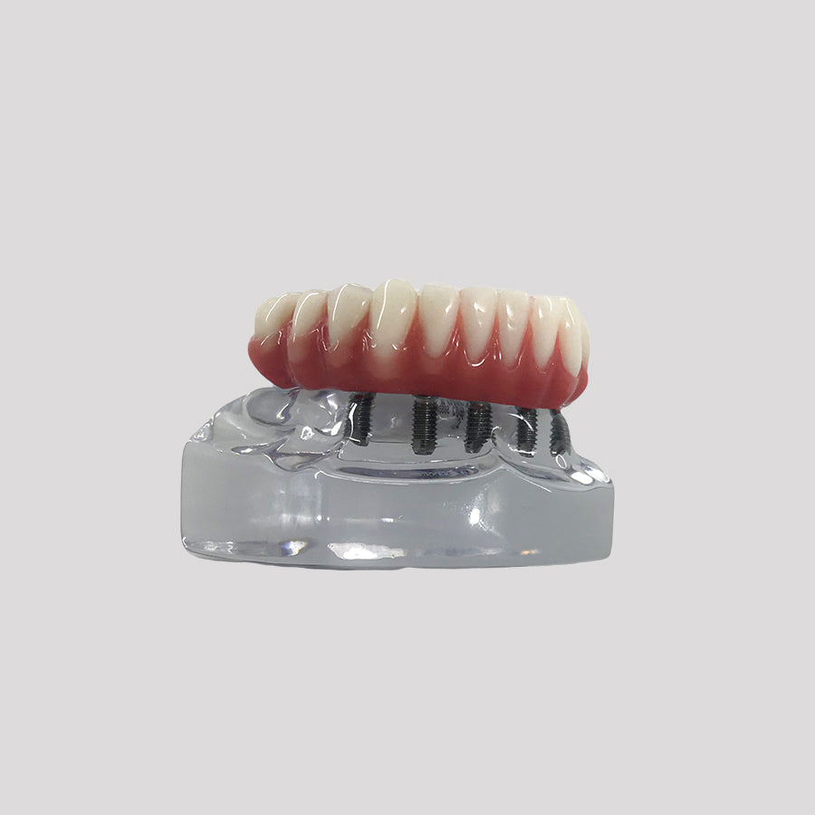 9569 - ACRYLIC MANDIBLE WITH PROTOCOL AND 5 IMPLANTS