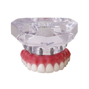 9571 – ACRYLIC MAXILLA WITH 6 IMPLANTS AND PROTOCOL