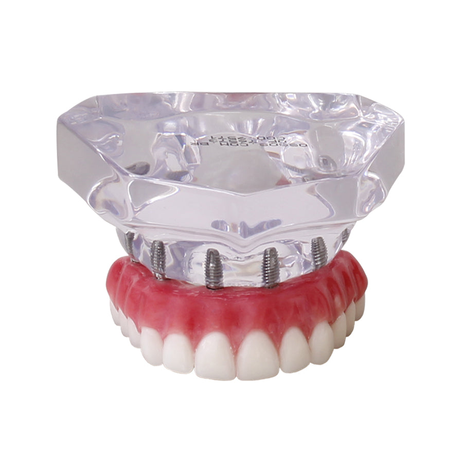 9571 – ACRYLIC MAXILLA WITH 6 IMPLANTS AND PROTOCOL