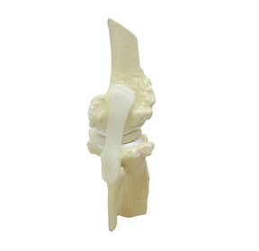 9597-4 - KNEE WITH ADVANCED OSTEOARTHRITIS