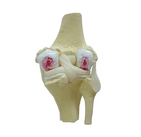 9597-4 - KNEE WITH ADVANCED OSTEOARTHRITIS