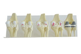 9597 - OSTEOARTHRITIS KNEE KIT (5 PIECES)